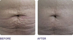 Soprano ST Laser Skin Titghtening - Before and After Images